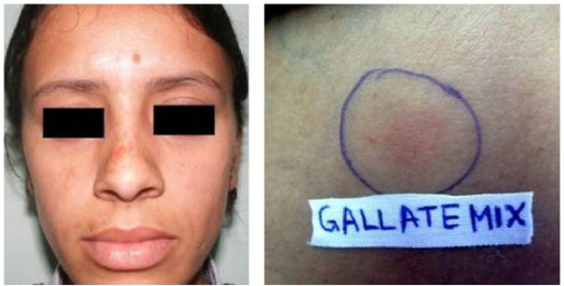 <p>Riehl Melanosis due to Gallate