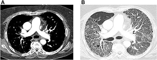 <p>Pulmonary Hypertension From Connective Tissue Disease on CT