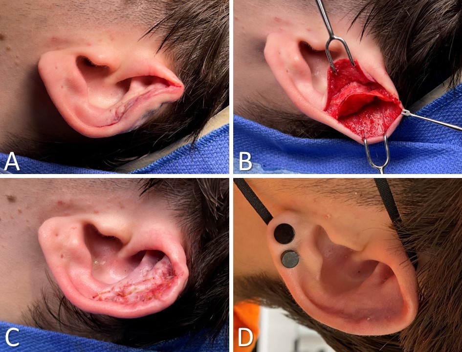 <p>Surgical Repair of Cauliflower Ear