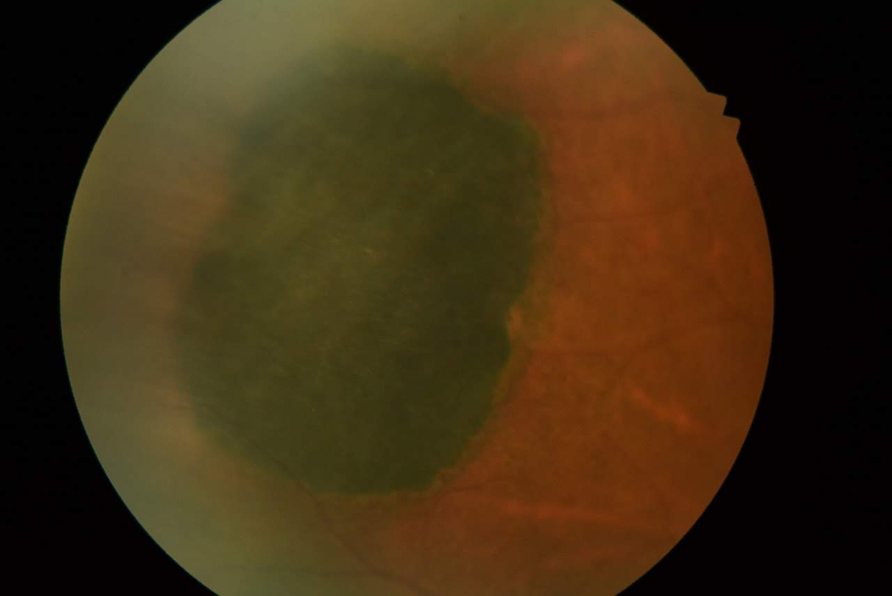 <p>Congenital Hypertrophy of the Retinal Pigmented Epithelium (CHRPE)