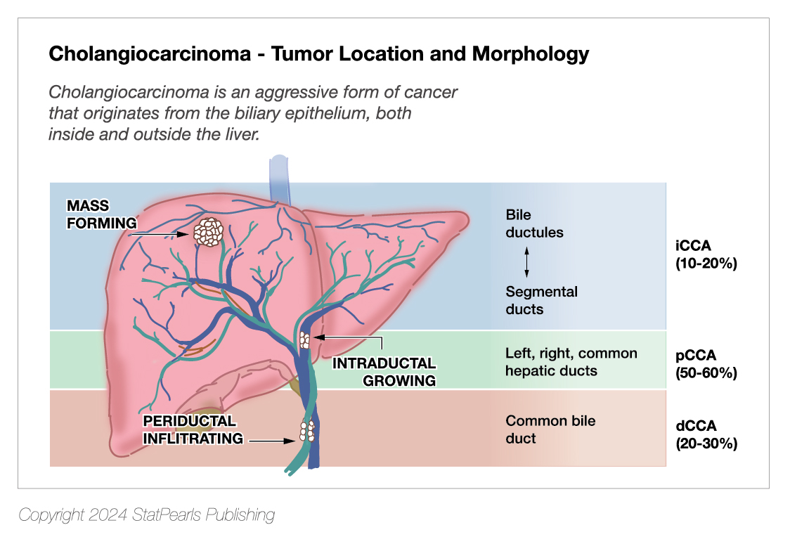 <p>Cholangiocarcinoma Tumor Location and Morphology</p>