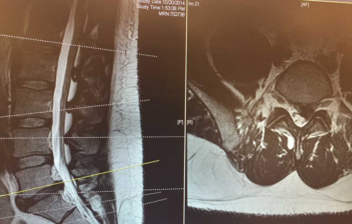 Lumbar MRI T2 sagital and axial slice