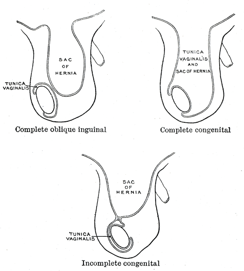 The Large Intestine, Varieties of oblique inguinal hernia, Complete oblique inguinal hernia, Sac of Hernia, Tunica vaginalis and Sac of Hernia, Complete congenita, Incomplete congenital 