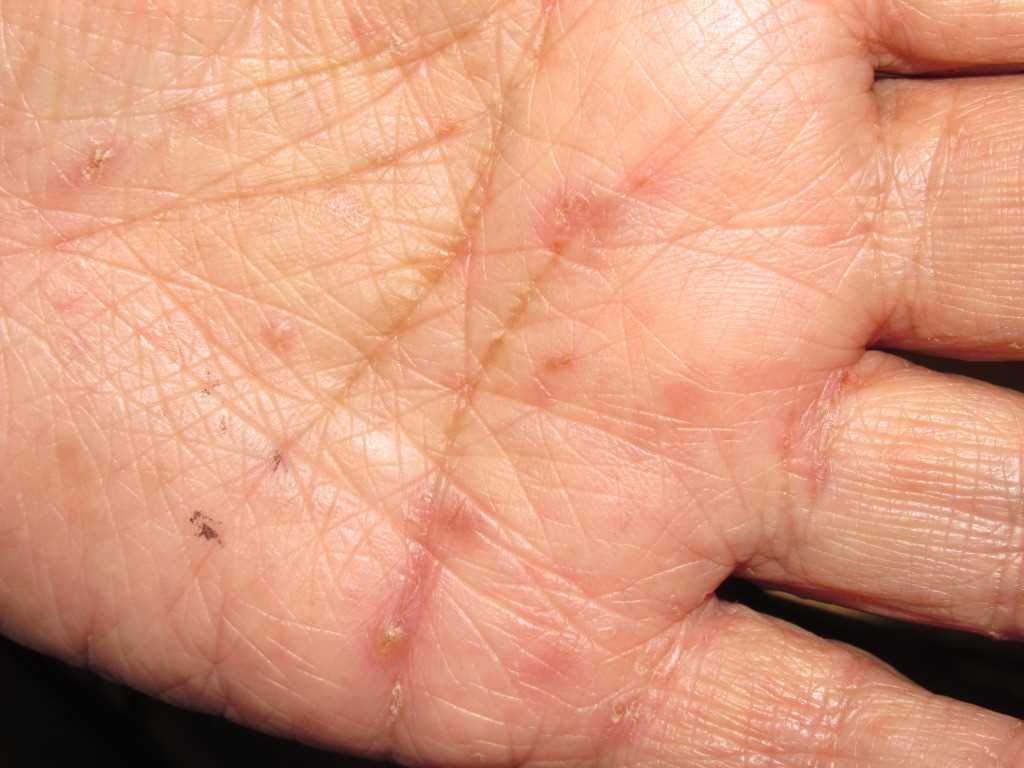 Scabies Burrows