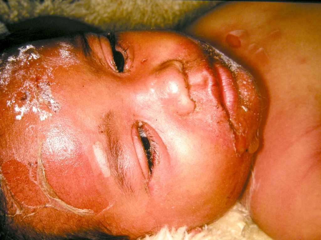 Staphylococcal Scalded Skin