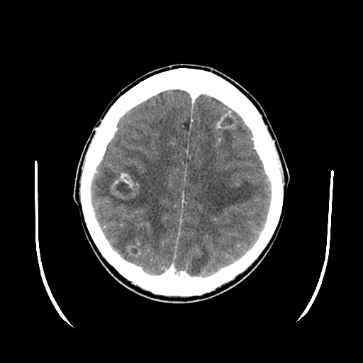Axial CT Brain with contrast abcesses