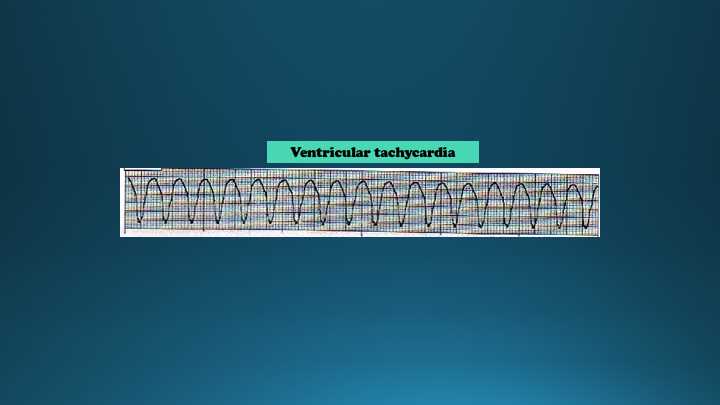 Ventricular Tachycardia rhythm example
