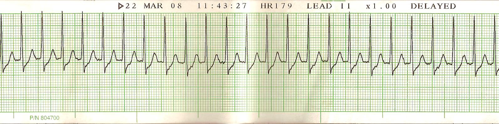 	
Lead II (2) Supraventricular tachycardia SVT 