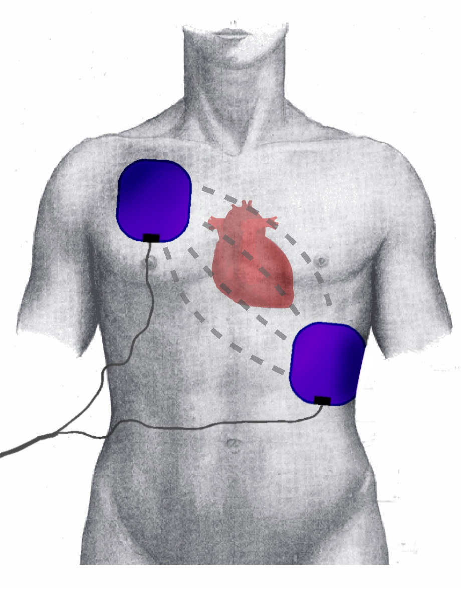 Position of Electrodes during Defibrillation/Cardioversion, Position of Heart, Flow of intrathrocical Energy during Shock.
