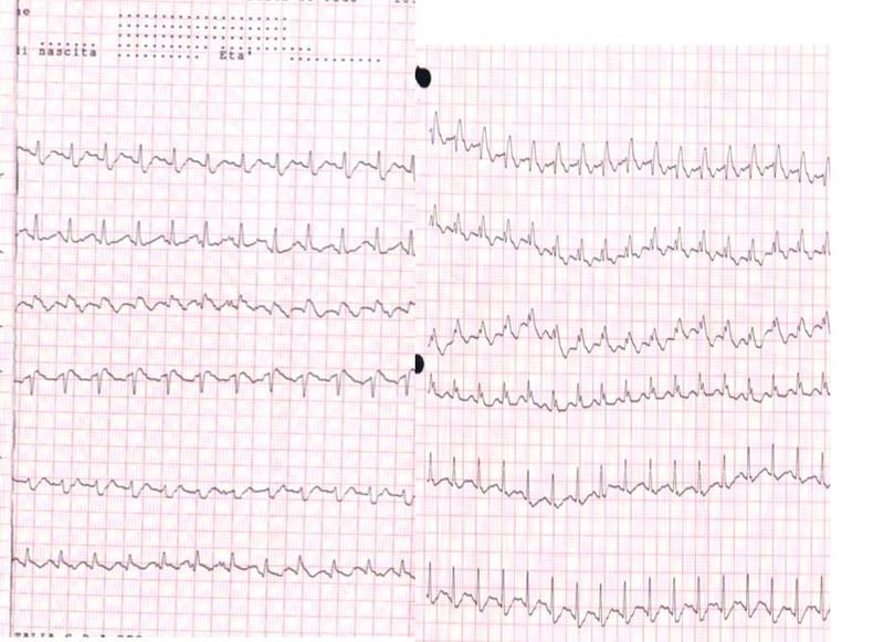 <p>ECG of A Patient With Pulmonary Embolism