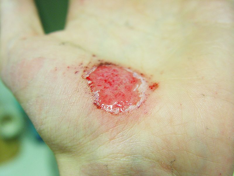 Abrasion caused by sliding fall on concrete