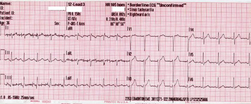  Sinus tachycardia as seen on ECG