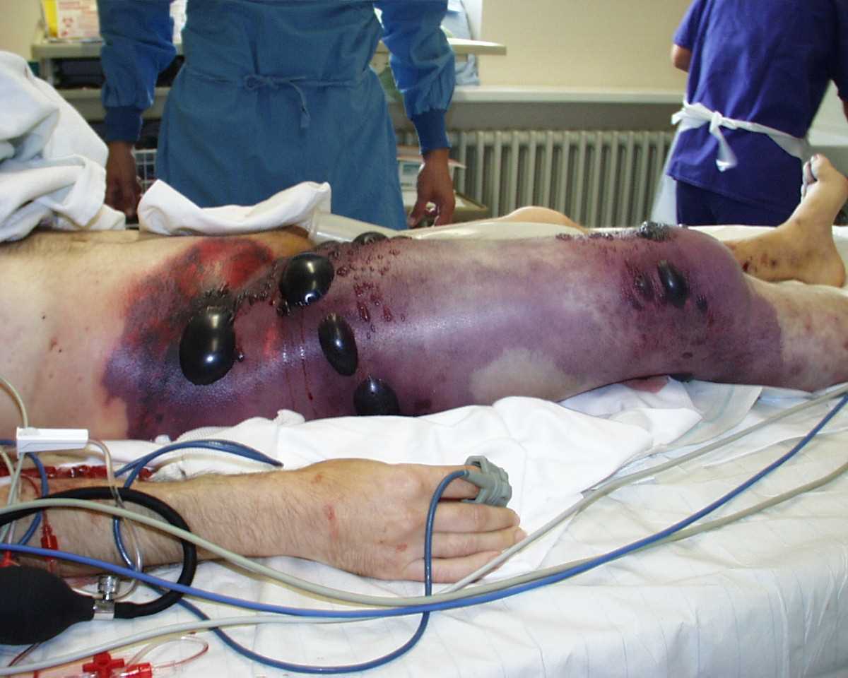 Gas gangrene of the right leg and pelvis, showing swelling and discoloration of the right thigh, bullae, and palpable crepitus
