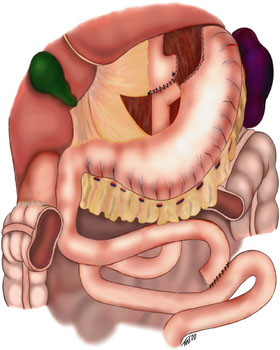 Schematic of gastric bypass using a Roux-en-Y anastomosis. The transverse colon is not shown so that the Roux-en-Y can be clearly seen. The variant seen in this image is retro comic, retro-gastric, because the distal small bowel that joins the proximal segment of the stomach is behind the transverse colon and stomach. 