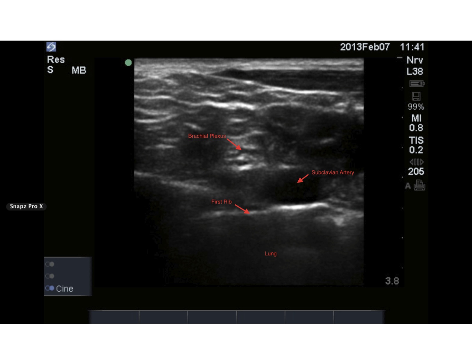 Supraclavicular Ultrasound-guided, Brachial Plexus Nerve Block