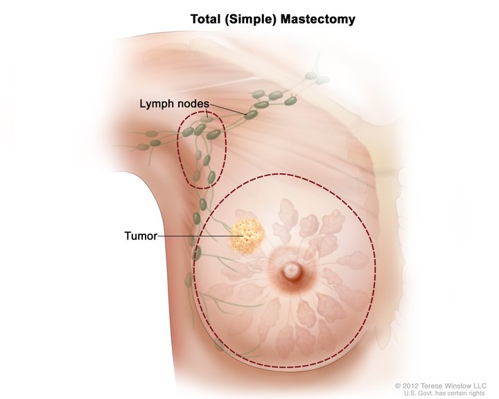 Total (simple) mastectomy; drawing shows removal of the breast and lymph nodes. The dotted line shows where the entire breast is removed. Some lymph nodes under the arm may also be removed