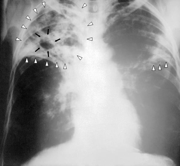 An anteroposterior X-ray of a patient diagnosed with advanced bilateral pulmonary tuberculosis. This AP X-ray of the chest reveals the presence of bilateral pulmonary infiltrate (white triangles), and „caving formation“ (black arrows) present in the right apical region. The diagnosis is far-advanced tuberculosis.