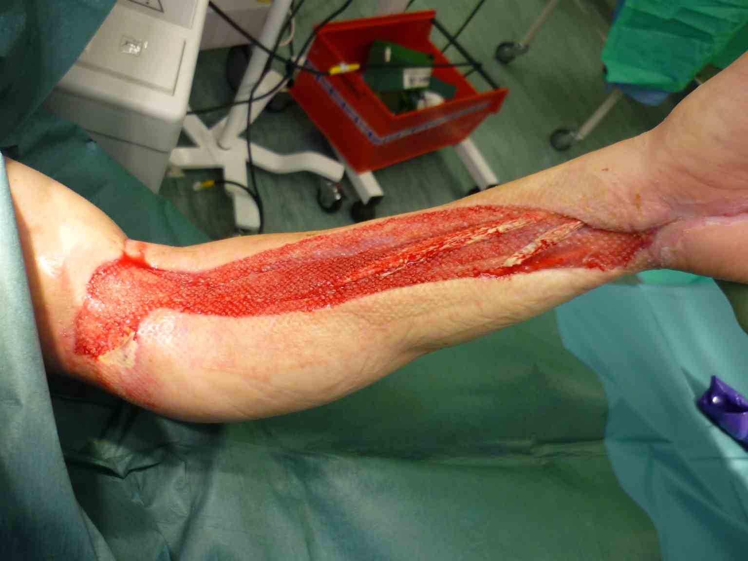 Forearm fasciotomy prior to skin grafting