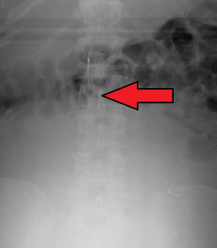 Inferior vena cava (IVC) filter as seen on plain X ray of the abdomen