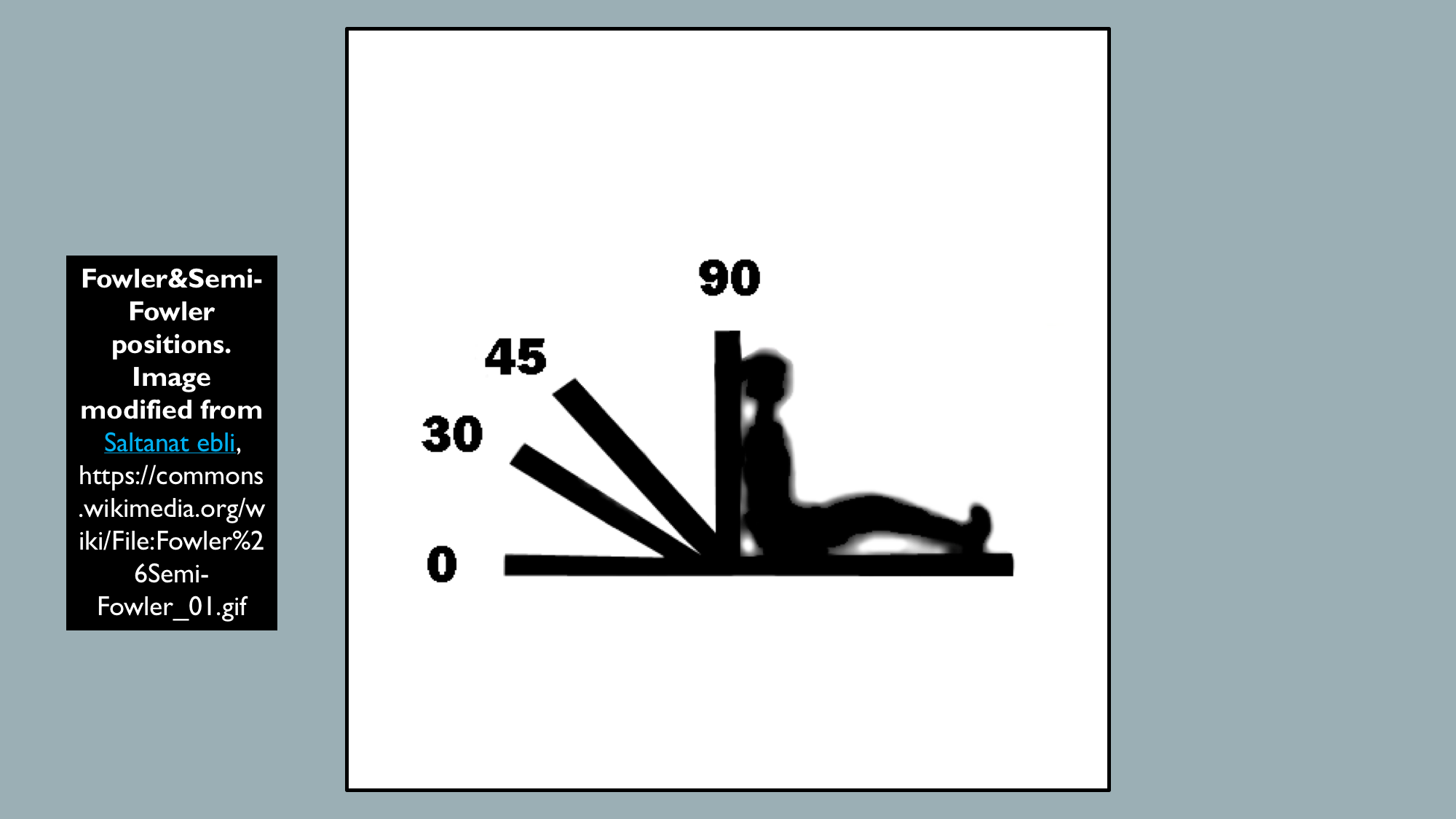 Fowler and Semi-Fowler positions, Full upright at 90 degree angle is High/Full Fowler's and tilted back at 30-45 degree angle is Semi-Fowler's position