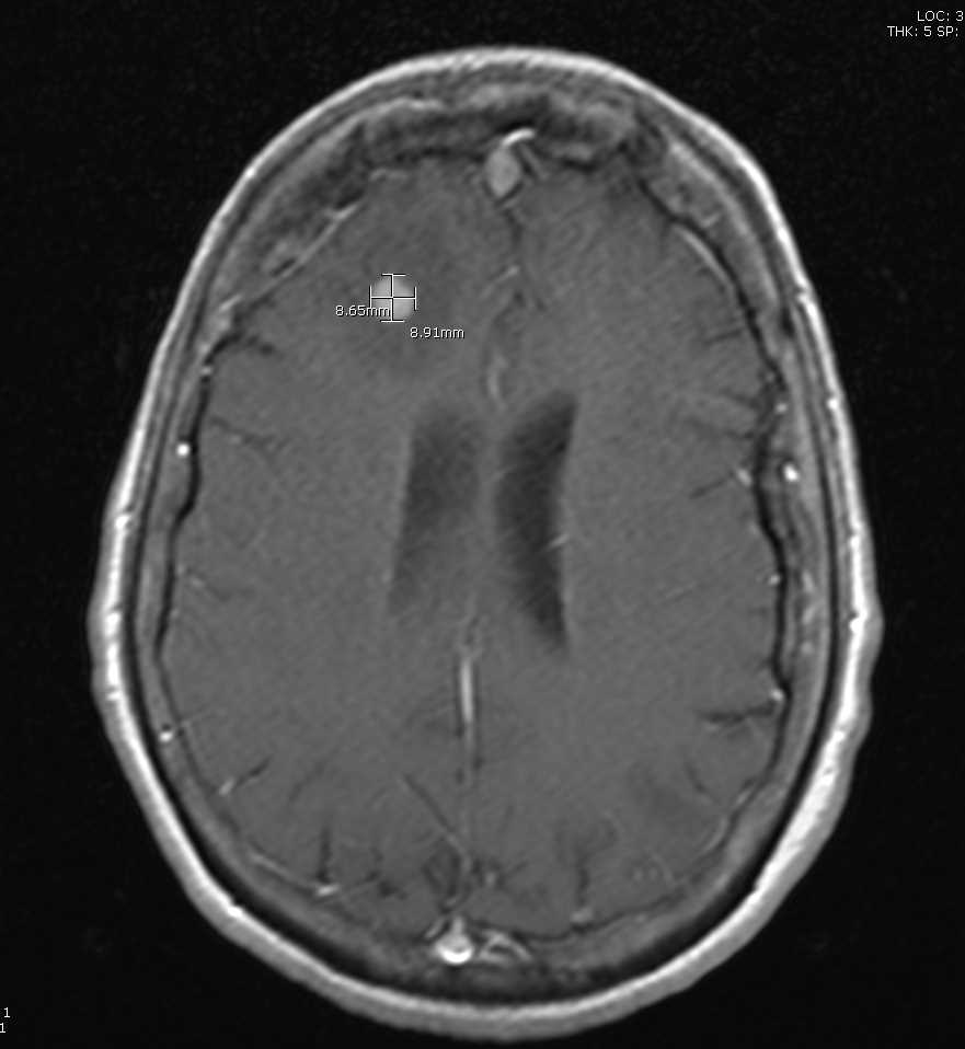76 year old woman with a lung cancer which has metastasized to the brain.  The T1-post contrast imaging is shown in the axial slice here showing the lesion and associated edema. 