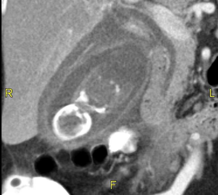 <p>Axial CT Abdomen Acute Cholecystitis</p>