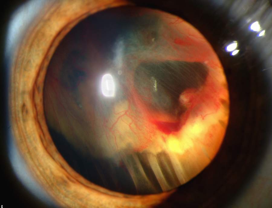Slit lamp photograph showing retinal detachment.