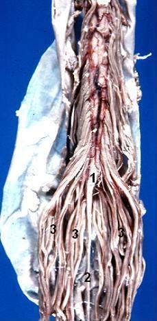 Human caudal spinal cord - Anterior view Conus medullaris Filum terminale Cauda equina (font: arial black, size: 14), 1) Conus medullaris, 2) Filum terminale,
3) Cauda equina
