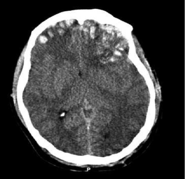 CT scan of patient with brain trauma. Caption reads, "Preoperative CT scan of patient while he had a GCS of 14." Accompanying text in article reads, "Emergent CT imaging revealed a sagittally oriented skull fracture extending from the vertex to the foramen magnum as well as a transverse parietal and temporal bone fracture. Multiple frontal, parietal, and temporal lobe contusions with associated interhemispheric hemorrhage and a left-sided subdural hematoma measuring 1.7 mm in greatest depth were appreciated. Effacement of the basilar cisterns was noted without shift of midline structures."