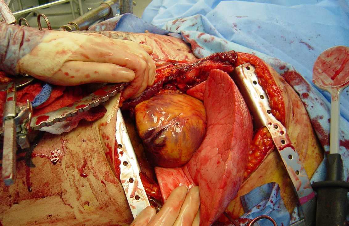 Emergency Department Thoracotomy