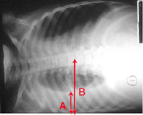 Pleural effusion Chest X-ray of a pleural effusion. The arrow A shows fluid layering in the right pleural cavity. The B arrow shows the normal width of the lung in the cavity

