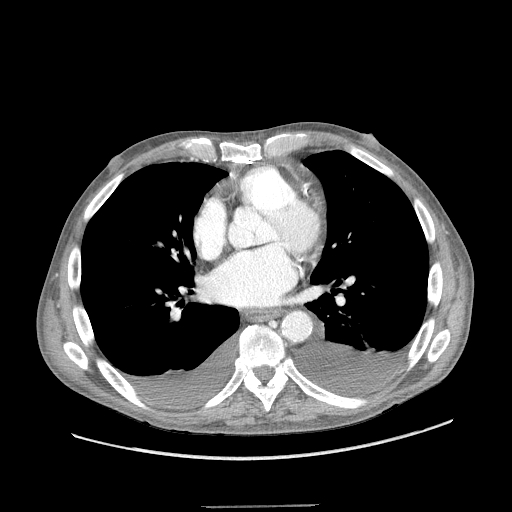 CT Chest bliateral Plueral Effusions