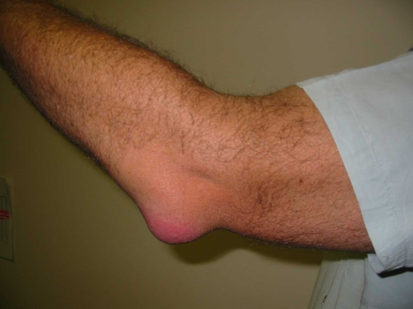 Bursitis of the elbow.