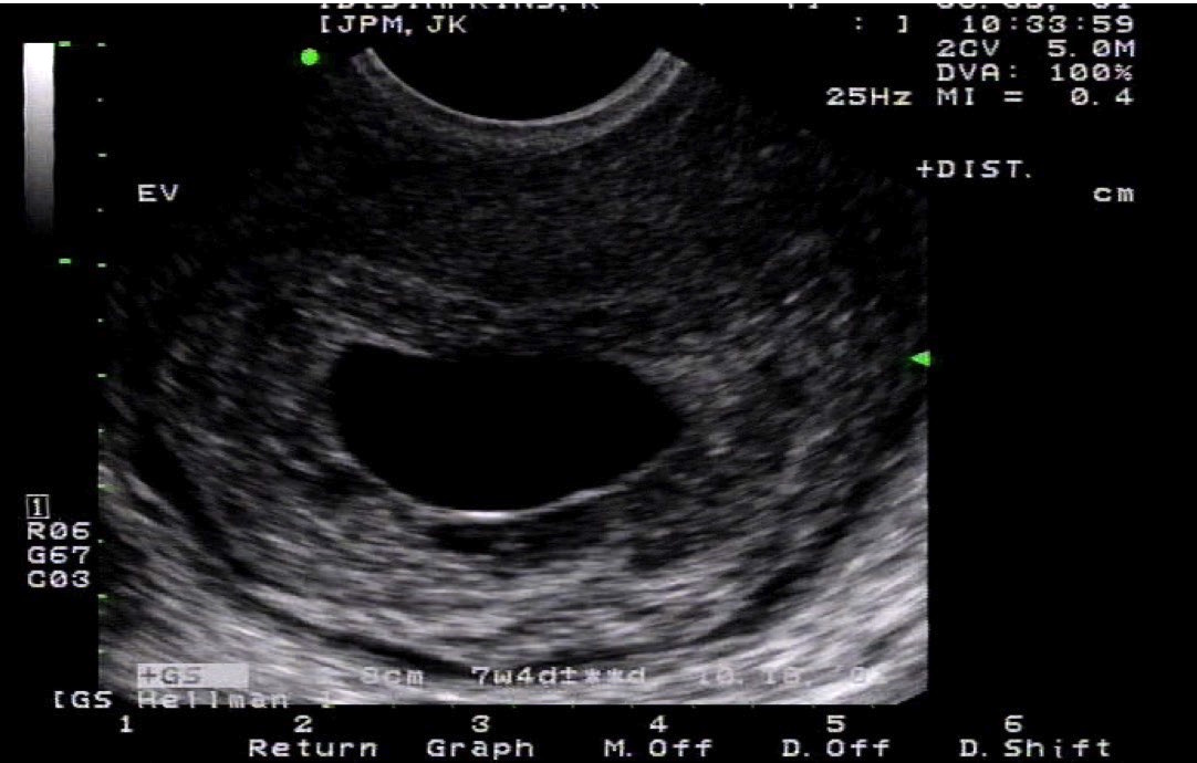 Endovaginal Ultrasound of the uterus in a coronal plane with a large empty gestational sac