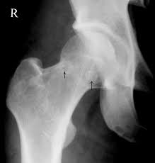 <p>Dysbaric Osteonecrosis of the Hip</p>