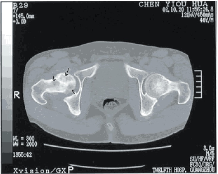 Dysbaric Osteonecrosis, CT scan