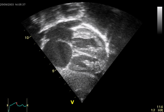This is an ultrasound picture of the heart, an echocardiogram. It depicts a atrial septal defect, of the ostium secundum type.

