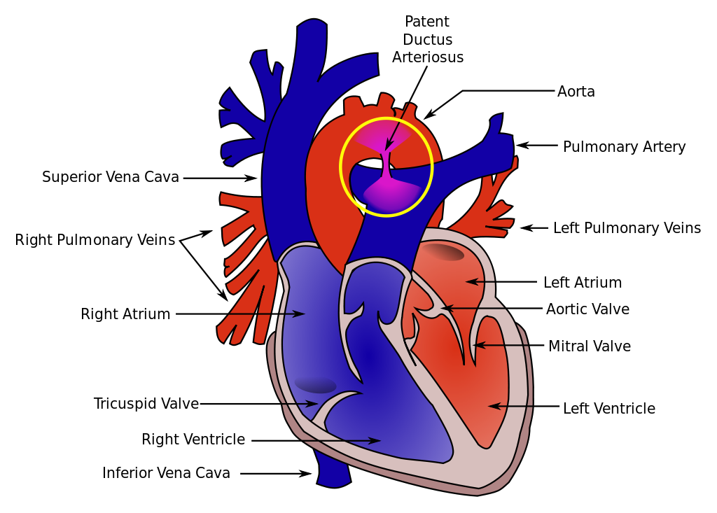 Heart cross section with Patent Ductus Arteriosus
 