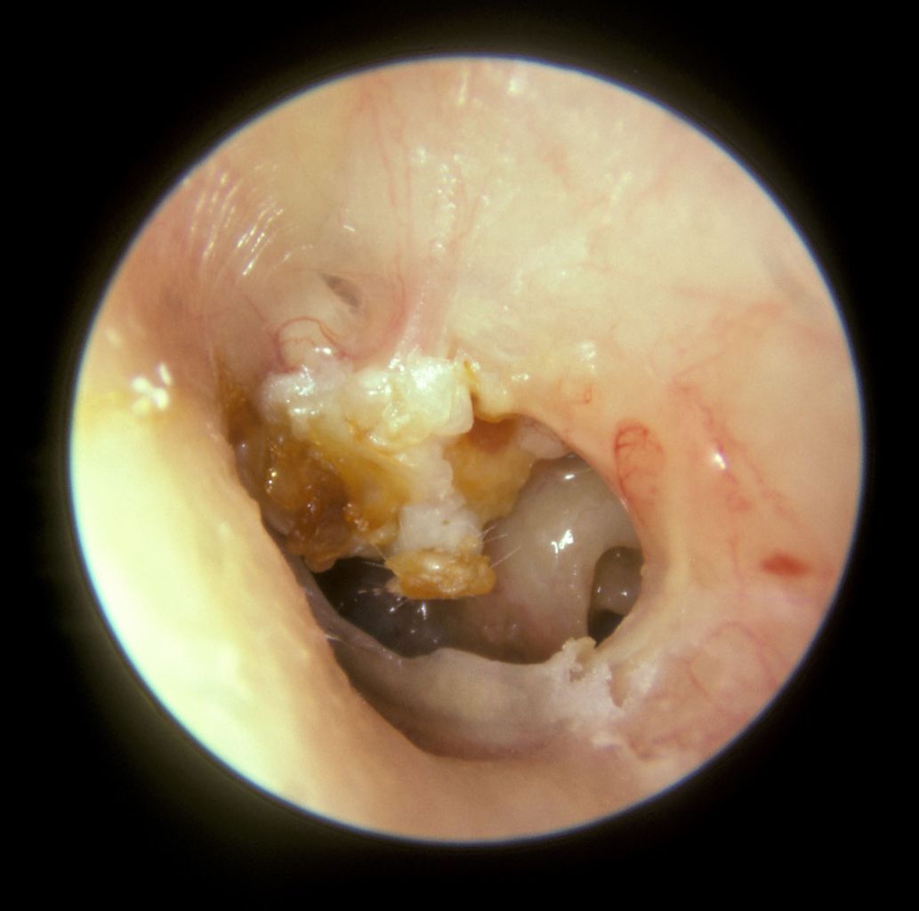 The large mass of white keratin debris in the left upper quadrant of this left tympanic membrane is a cholesteatoma. The majority of the tympanic membrane is missing [perforation]. In the lower right quadrant the round window niche on the medial wall middleware can be seen.