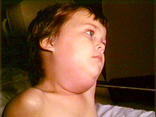<p>Mumps Parotitis in&nbsp;a Pediatric Patient
