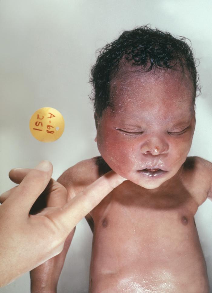  "This photograph depicts a newborn with the genetic disorder Down Syndrome, due to the presence of an extra 21st chromosome."