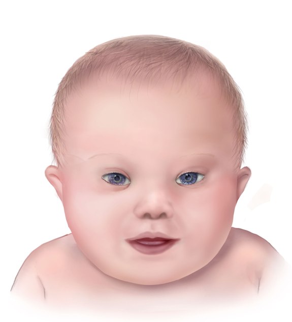  A drawing of the facial features of Down syndrome