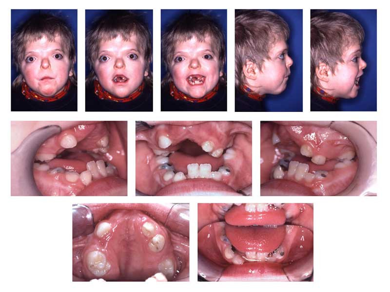 Patient with Apert syndrome, Extraorally: Hypertelorism, vertical excess of the lower third of the face, trapezoidal upper lip, forced lip closure possible, but difficult. Intraorally: Dentitio tarda, crowding, Angle Class III with dental compensation by retrusion of lower incisors, circular open bite with unilateral crossbite.