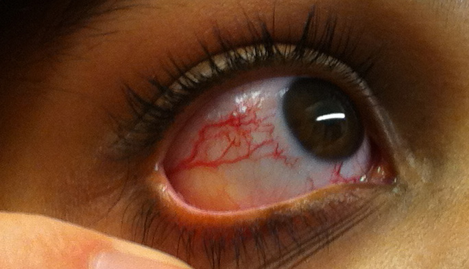 This photo shows the prominent ocular telangiectasia that can be seen in some people with A-T.