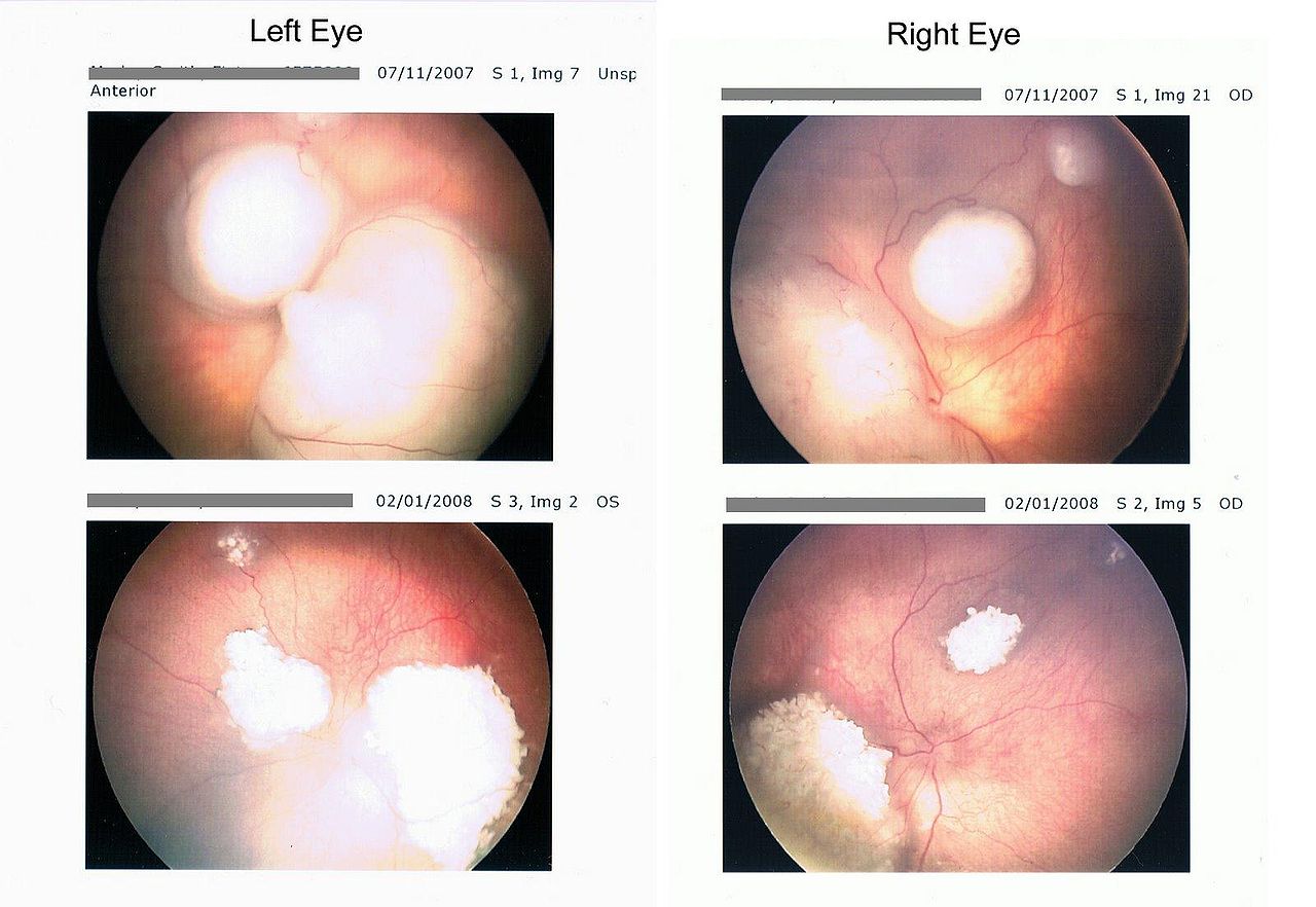 Retinoblastoma retina scan before and after chemotherapy