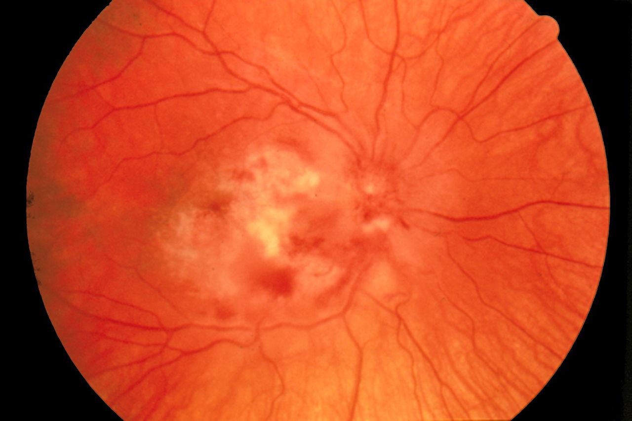 Cytomegalovirus retinitis, Fundus