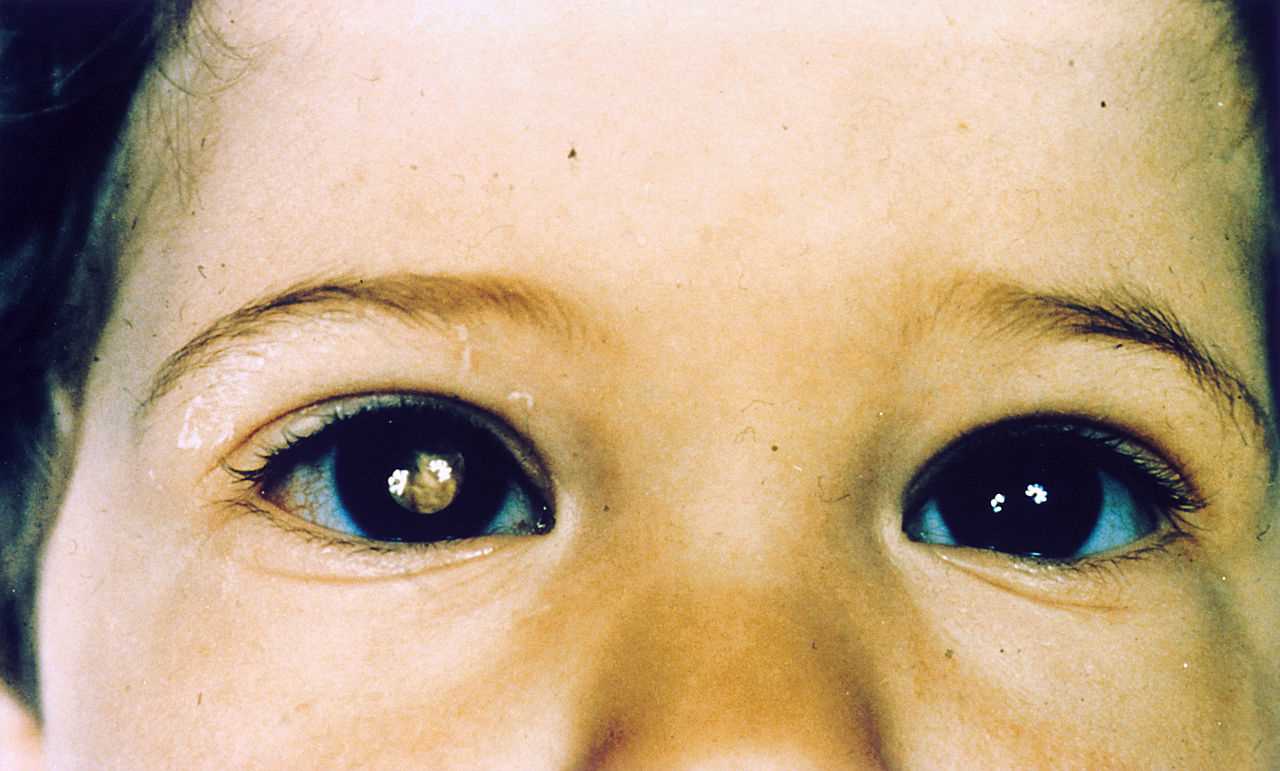 Shows close-up of human face, straight on, showing both eyes, an example of a patient with retinoblastoma.