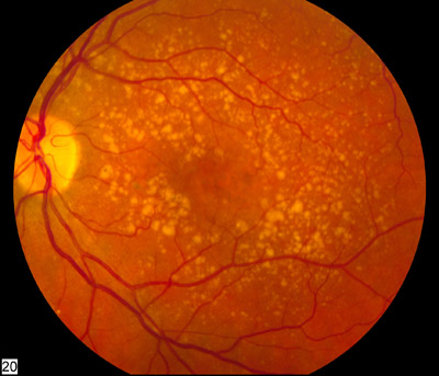 Picture of the back of the eye showing intermediate age-related macular degeneration