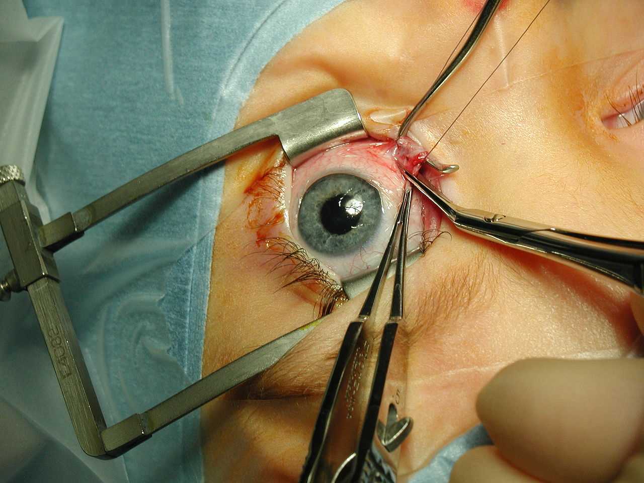  Strabismus surgery—medial rectus muscle being disinserted following pre-placement of polyglactin 910 sutures. A Castroviejo locking forceps is grasping the superior pole of the muscle, while a Manson-Aebli scissors does the cutting. The eyelids are being held by a Cook speculum.