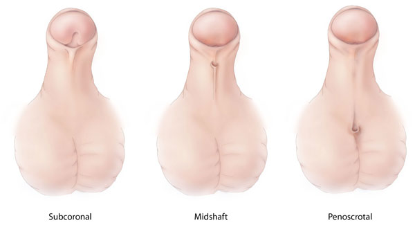 Different types of hypospadias, Subcoronal Hypospadias, Midshaft Hypospadias, Penoscrotal Hypospadias  